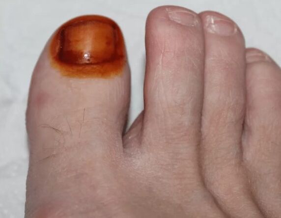 Traitement de l'iode fongique