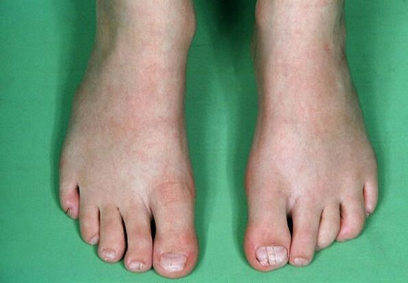 Le champignon sur les jambes