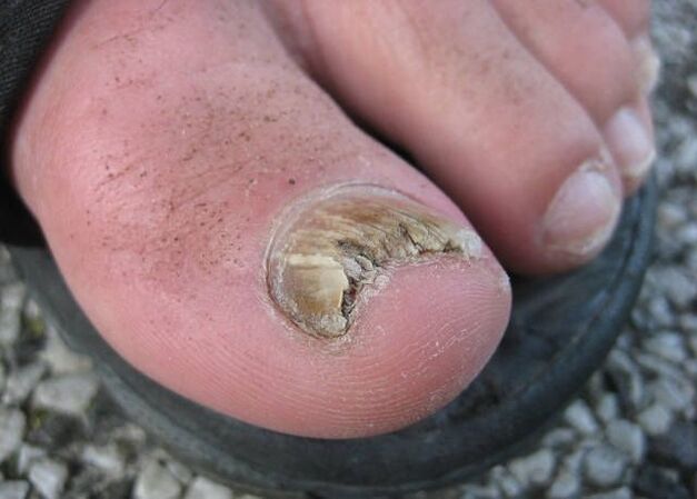 Le résultat de la négligence