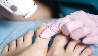 Traitement matériel des champignons sur les jambes