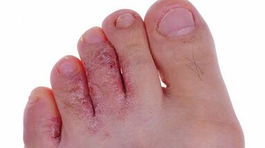 Types et étapes du développement de champignons sur les jambes