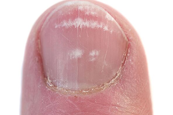 Les premiers signes et symptômes