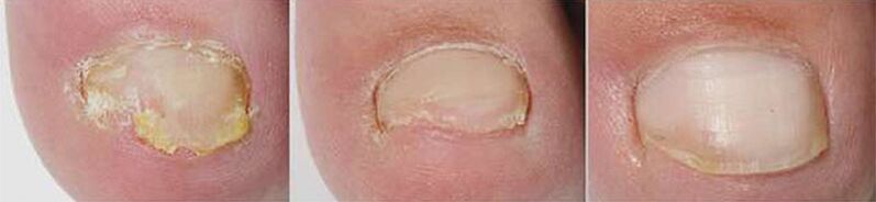 Résultats de la thérapie