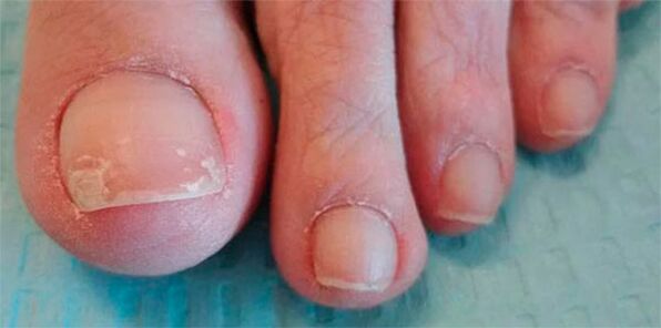 étapes des jambes fongiques