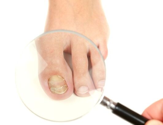 champignon des ongles