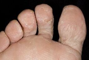 symptômes de champignons sur la peau des pieds