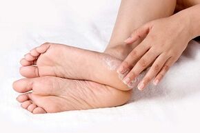 traitement des champignons de la peau des pieds avec de la crème