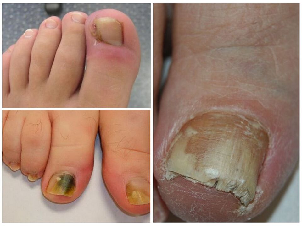 infection fongique des ongles des pieds