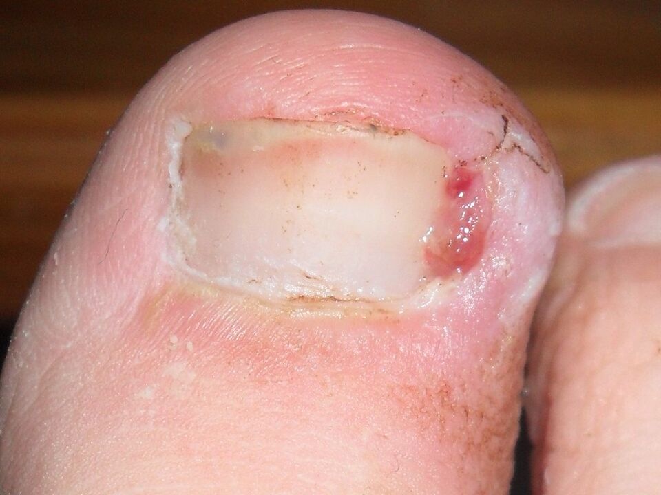 ongle incarné comme symptôme d'une infection fongique