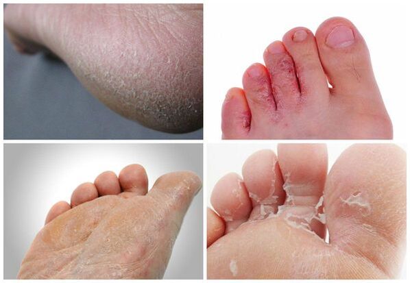 Les principales manifestations de la mycose des pieds sont la kératinisation de la peau, les crevasses, la desquamation.