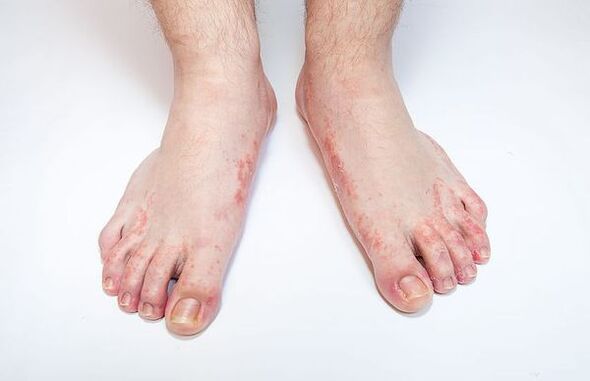 Maladie fongique de la peau des pieds
