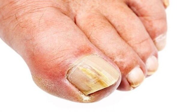 Onychomycose - champignon des ongles des pieds