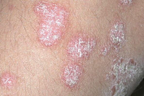 Psoriasis causé par une infection fongique