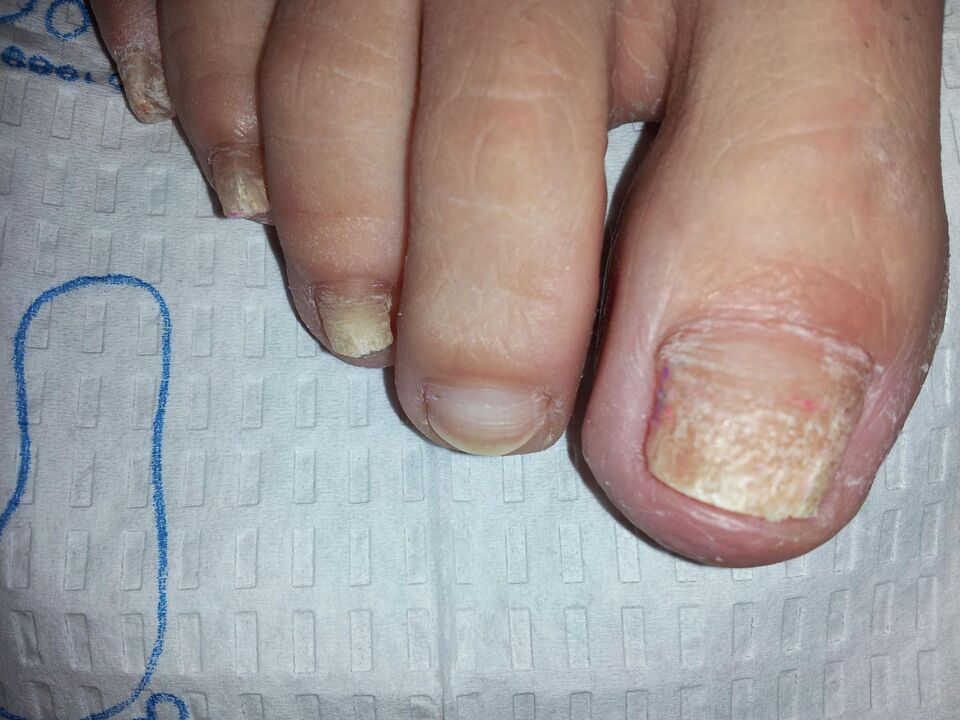 comment traiter la mycose des ongles avec de la chélidoine