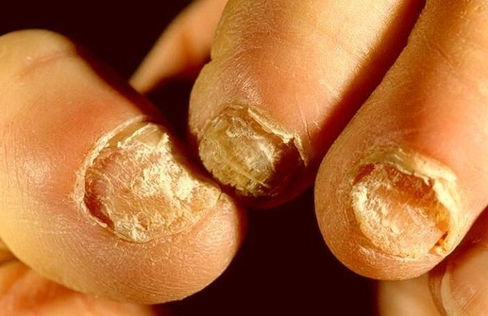 mycose des ongles comment traiter