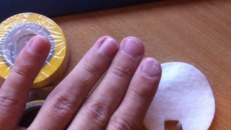 mycose des ongles et son traitement avec des remèdes populaires