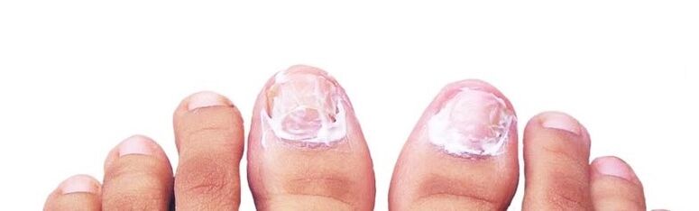 pommade pour les ongles contre les champignons