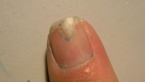 symptômes de mycose des ongles