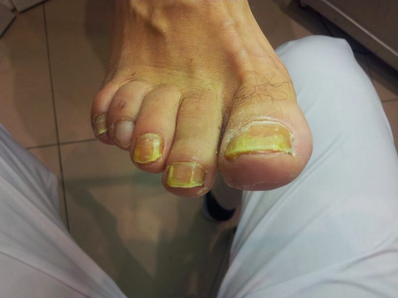 ongles jaunes à cause de champignons