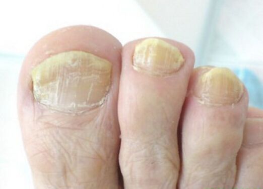 champignon avancé sur les ongles des pieds