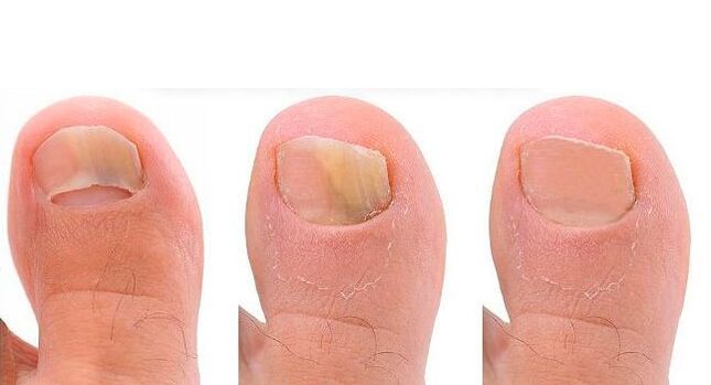 stades de développement de la mycose des ongles
